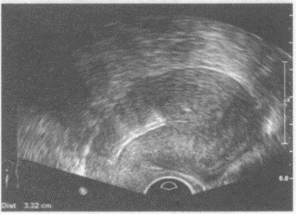 临床资料：女，30岁，自诉放置节育器5年，腹部不适。超声综合描述：经阴道扫查子宫后位，形态大小正常，