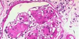 一患者肾病理(PAS染色)示:系膜基质结节状增多，形成Kimme1stie1-Wi1son结节，GB