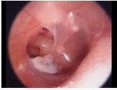 慢性化脓性中耳炎，鼓膜形状如下图，称为（）。