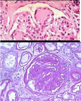 下述两张病理图片示肾小球毛细血管袢呈结节样的粉红色玻璃样物质(K-W结节)。其诊断为()
