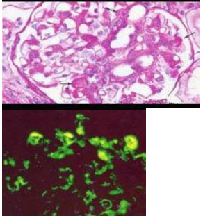 阅读下述两张病理图片(光镜PAS染色，免疫荧光IgA阳性)后，可诊断()