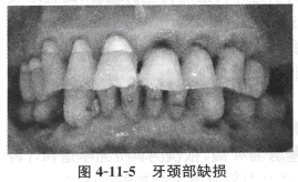患者，男，45岁，职员。	主诉：刷牙时左侧后牙酸痛约3个月。	现病史：3个月以来，刷牙、吃酸、甜食物