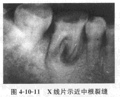 患者，男，65岁，退休。	主诉：左下后牙补牙材料脱落2个月余。	现病史：6年前因为牙齿遇冷热痛、晚上
