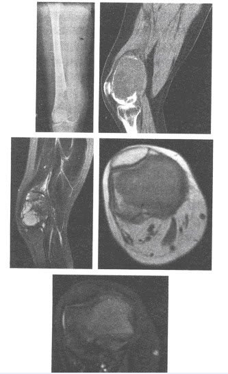 女，28岁，右股骨下端肿痛半年余，局部活动稍受限。膝关节DR正位，CT矢状面MPR重组像，MRI矢状