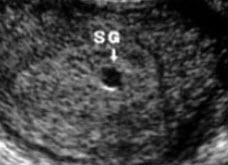 女，26岁，停经35天，B超宫腔显示如图，可考虑_____。	