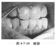 患者，男，13岁，学生。	主诉：左下后牙咬食物时经常出血3个月余。	现病史：左下后经常食物嵌入牙洞1