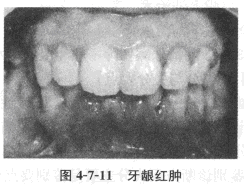 患者，男，13岁，学生。	主诉：左下后牙咬食物时经常出血3个月余。	现病史：左下后经常食物嵌入牙洞1