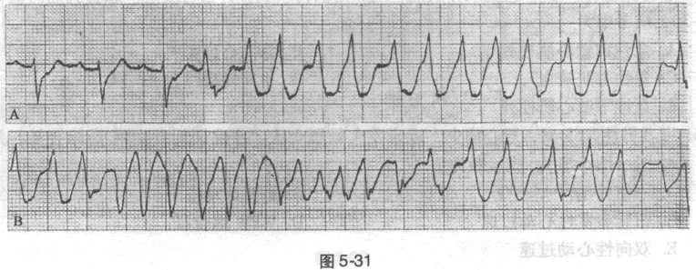 患者男性，63岁，冠心病史，近来发生晕厥2次。住院期间发生阿-斯综合征，并记录到如下心电图（图5-3