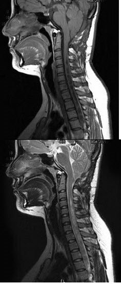 患者，女，16岁，四肢活动不灵半年，走路不稳2个月。行MRI检查如下图，最可能的诊断为()