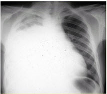 该患者的初步诊断是（）（提示：胸部X线检查如图所示。）