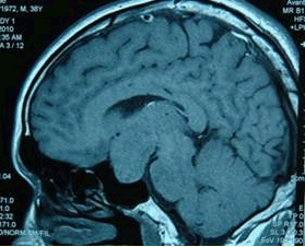 提示颅脑X线片：蝶鞍球形扩大；颅脑MR：鞍内肿瘤侵袭鞍上（下图）。根据临床及影像特点，初步诊断考虑为