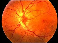 患者，男性，35岁，诉双眼视物模糊1月余，曾患多发性动脉炎，眼底检查如图，对该疾病描述正确的为（）