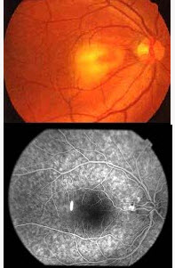 患者，女性，30岁，左眼视力下降1周，检查左眼视力0.8，眼前段（-），眼底检查如图，对该病治疗描述