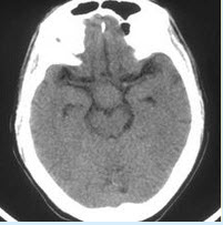 提示：入院后行颅脑MRI扫描（见下图）。可以排除的诊断包括（）