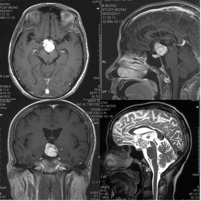 提示：入院后行颅脑MRI扫描（见下图）。可以排除的诊断包括（）