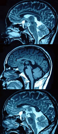 男，47岁，头痛三年余，最近2个月感觉视力下降，MRI检查如图，最可能的诊断为()