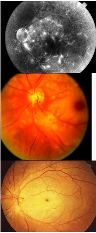 患者，男性，64岁，诉右眼突然视力丧失，其眼底检查如图，该病急诊处理不包括（）