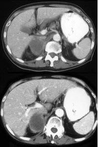 男，75岁，右侧胸痛伴咯血3月余，胸部CT提示右侧中央型肺癌，请结合图像，作出诊断()