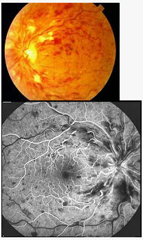 患者，男性，60岁，高血压病史10年，近1周突感左眼视力下降，视力由原来的0.8降至0.04，裂隙灯