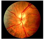 患者，女性，60岁，左眼视力下降2天，检查：左眼视力为0.3，视乳头水肿，边界不清，可见局限性颜色变