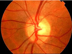 患儿，男性，8岁，左眼视力模糊1周，并有眼球转动时疼痛，之前有感冒史。检查瞳孔对光反射略迟钝，眼底检