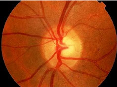 患儿，男性，7岁，左眼视力模糊1周，并有眼球转动时疼痛，之前有感冒史。检查瞳孔对光反射略迟钝，眼底检