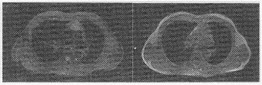 患者，男，63岁，重症肌无力1个月，胸部MRI平扫图像如下：最可能的诊断为（）