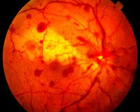 下面对非缺血型视网膜中央静脉阻塞（如图）描述错误的是（）