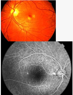 患者，男，30岁，左眼视物不清2天，检查左眼视力0.9，眼前段（-），眼底检查如图，不符合该病的临床