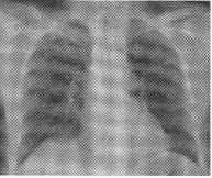 患者，女，28岁，轻咳两月，有盗汗。胸片如图：本例最可能的诊断为（）