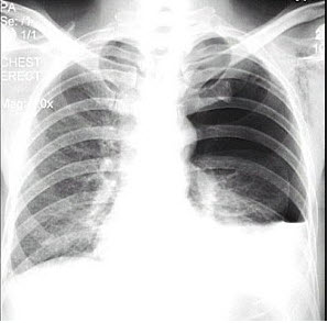 男性患者，32岁，两天前被人踢伤胸部，逐渐感胸闷，呼吸困难，X线检查如图，最佳诊断为()