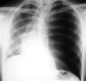 23岁，男，左侧胸壁刺伤3小时，呼吸窘迫，请结合胸片选出最可能的诊断()