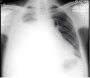 男性患者，38岁，感胸闷气逼2周，近来加剧，不发热。X线检查如图，最佳诊断是()