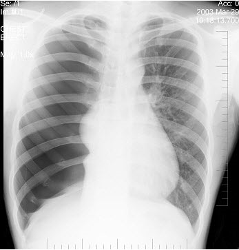 男性患者，22岁，突感呼吸困难，胸片检查如图，最可能的诊断是()