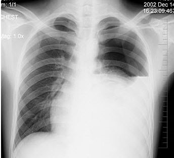 患者男性，18岁，感胸闷气逼，胸片检查如图，最合理的诊断是()