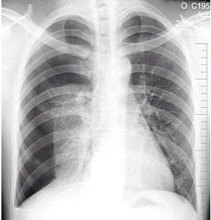 男性患者，28岁，夜间突感胸闷，呼吸困难就诊，X线检查如图，最佳的诊断是()