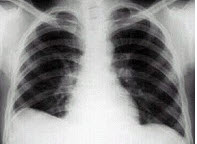 男，23岁，胸闷伴胸痛，胸片如图，最可能的诊断为()