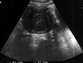 患者女45岁，阴道不规则出血数月，妇检：子宫体积增大，如球形，B超检查声像图如图所示应诊断为()
