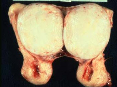 图中为子宫肌瘤，关于其手术治疗下列哪项是不正确的()