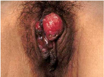 图为外阴恶性黑色素瘤，其手术切除的范围应在病灶外()