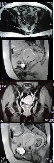 55岁女性患者，绝经后阴道排液半年余，行MRI检查，如图所示，最佳答案是()