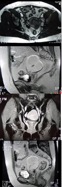 65岁女性患者，绝经后阴道排液半年余，行MRI检查，如图所示，最佳答案是()