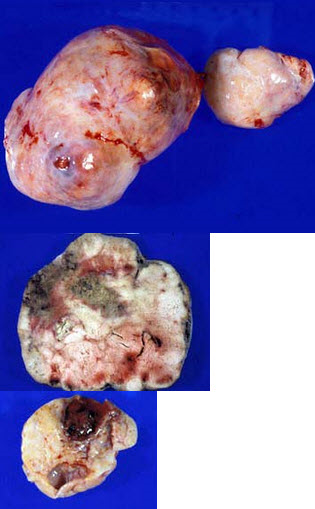 图中均为一种卵巢中等恶性的实性肿瘤，触之如橡皮样间质中常有淋巴细胞浸润，对放疗特别敏感.可能为()