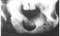 在X线片上能看到中央性颌骨骨髓炎骨质广泛破坏时间一般是（）	A. 1周B. B.1～2周C. C.3
