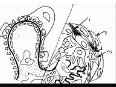 对比阅读下面左正常肾小球与右异常肾小球模式图(1指GBM断裂，纤维蛋白漏出，2指上皮细胞，3指单核巨