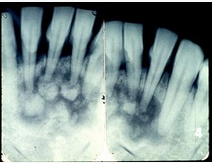 图为牙骨质瘤的X线表现，关于此病描述不正确的是（）