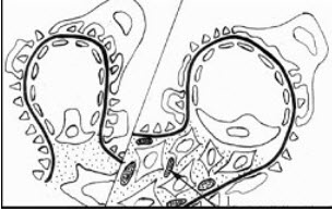 对比阅读下面左正常肾小球与右异常肾小球模式图(1指内皮下电子致密物沉积)后，其病理类型诊断为()