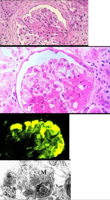 图-1为HE染色，图-2为PAS染色，图-3免疫荧光镜下可见IgM团块状沉积于病灶区，图-4电镜下可