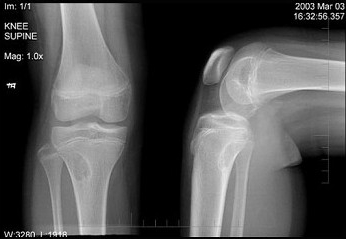 左膝关节酸胀不适，摄片发现左胫骨上段局限性骨质改变如图示，最可能的诊断是（）