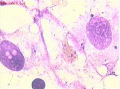 下列图片为病人的骨髓图片，该患者血常规WBC1.2×109/L，RBC1.32×1012/L，Hb5